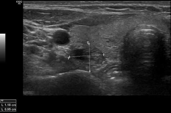 RIZ-Augsburg-Schilddrüsen-Sonografie