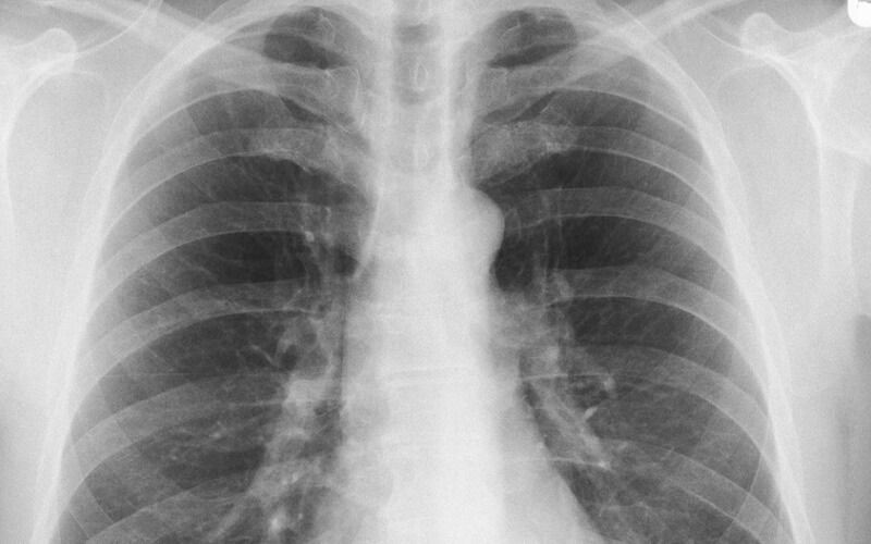 Untersuchung der Lunge