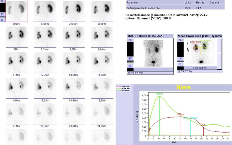 Szintigraphie, SPECT und SPECT-CT