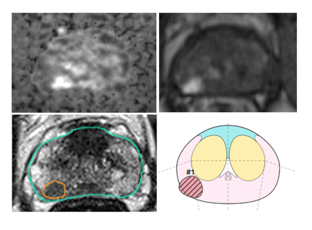 mpMRT Prostata
