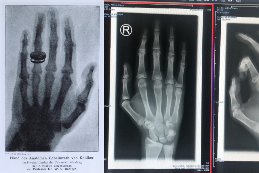 Röntgen einer Hand damals und heute